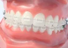 Ortodonzia fissa Manduria